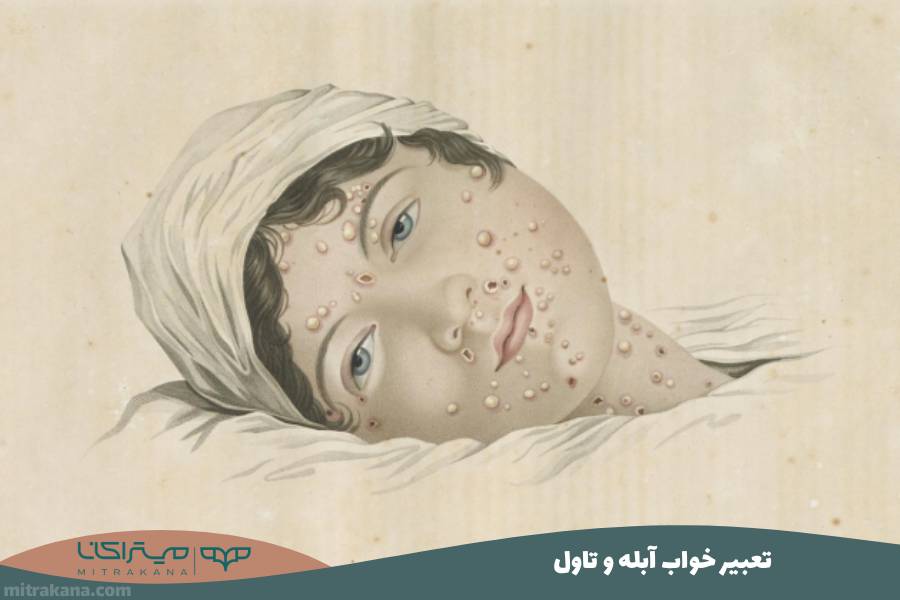 تعبیر خواب آبله و تاول